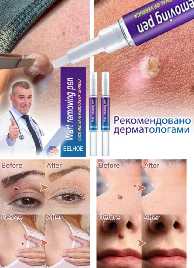 Wart Remover Skin Pen Gel - All Natural Way - Painless & Non Surgical