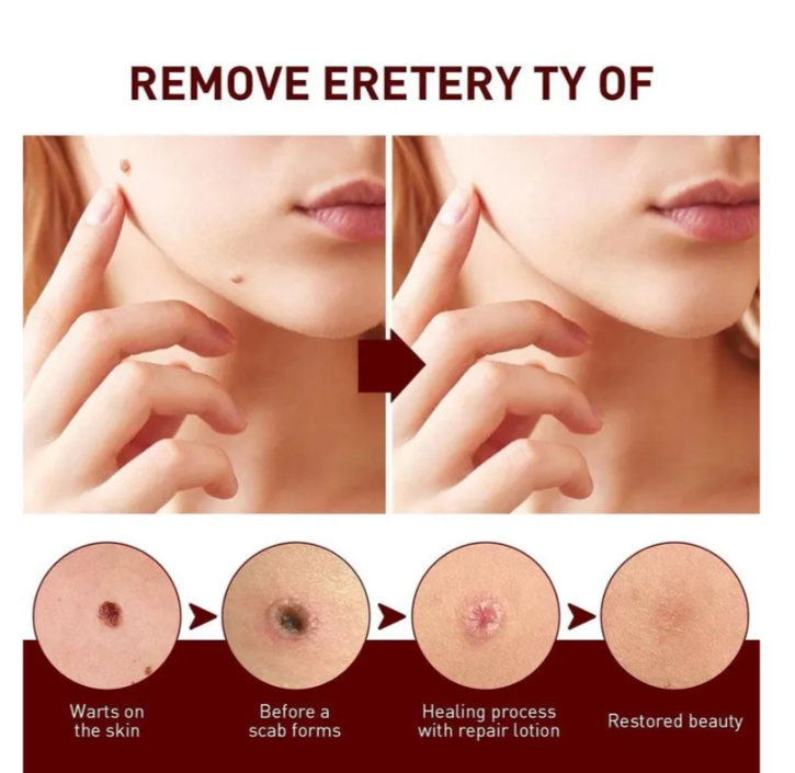 Wart Remover Skin Pen Gel - All Natural Way - Painless & Non Surgical