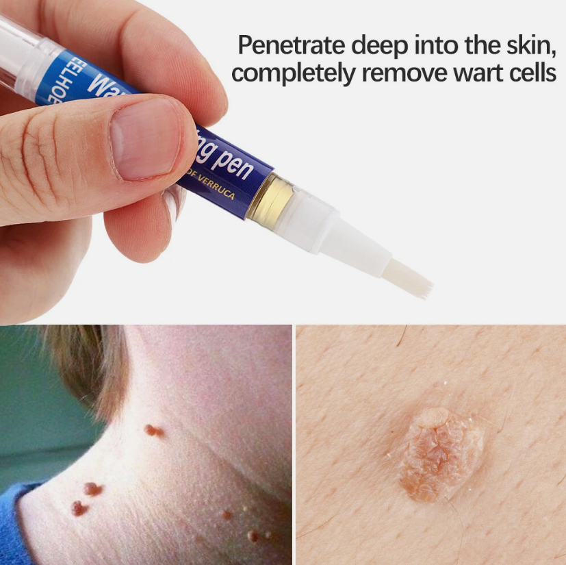 Wart Remover Skin Pen Gel - All Natural Way - Painless & Non Surgical
